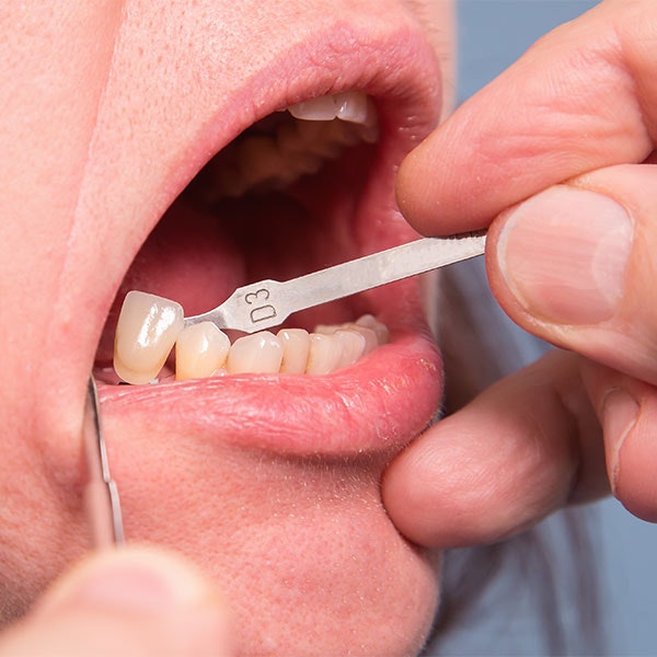 dentist placing a dental crown 