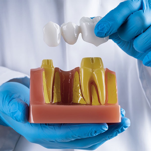 Dental bridge being placed on a model of teeth and gums