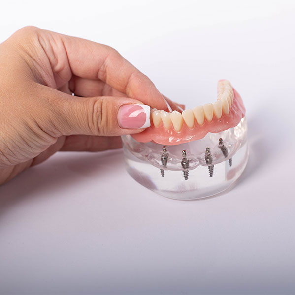 Model of an All-on-4 implant