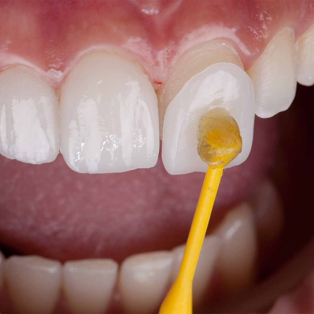 porcelain veneer being applied