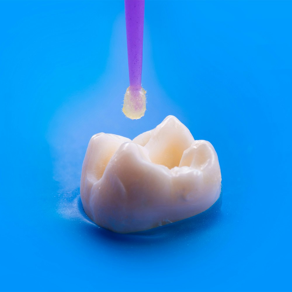 dental bonding tooth