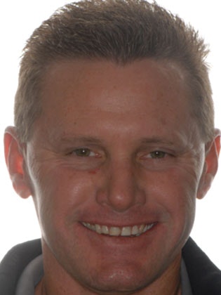 Dr. Ace Jovanovski's patient before crowns