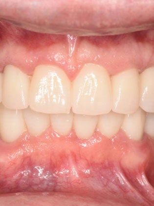 Dr. Ace Jovanovski's patient after implants