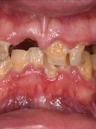 Dr. Ace Jovanovski's patient before implants