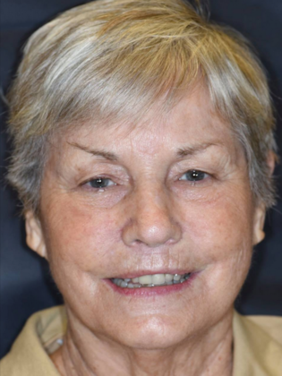 Dr. Ace Jovanovski's patient before veneers