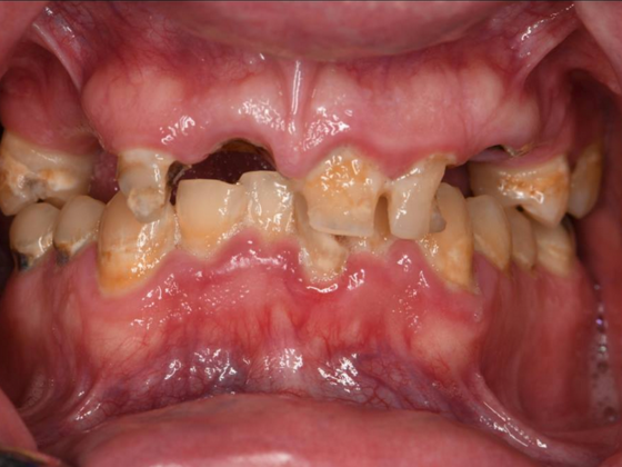 Dr. Ace Jovanovski's patient before implant dentistry