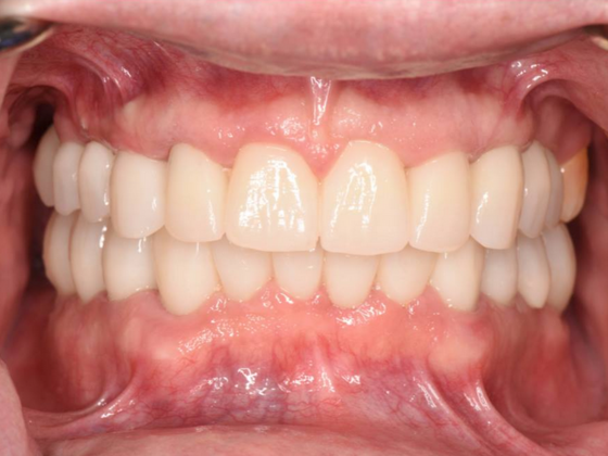 Dr. Ace Jovanovski's patient after implant dentistry
