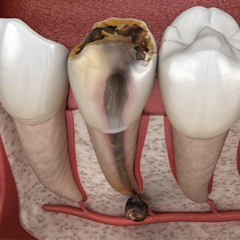 Infected root canal