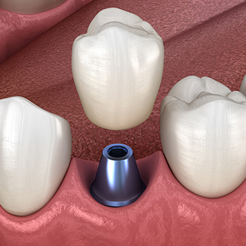 Implant-supported crown