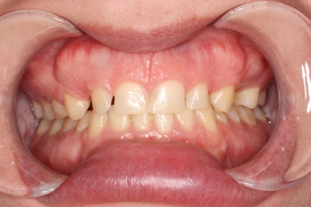 Before a dental crown