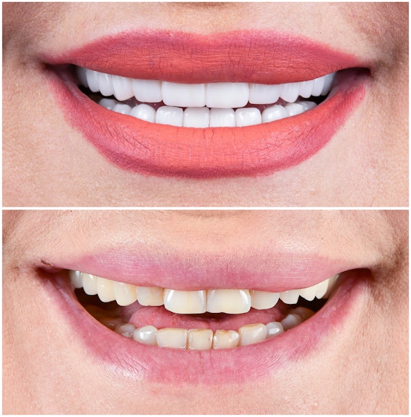 Before and after dental veneers