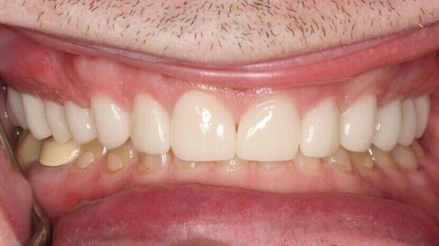 Ata Dental patient After Crowns and Veneers
