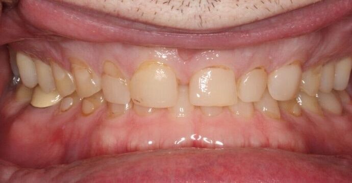 Ata Dental patient Before Crowns and Veneers