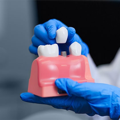 Dental crown model