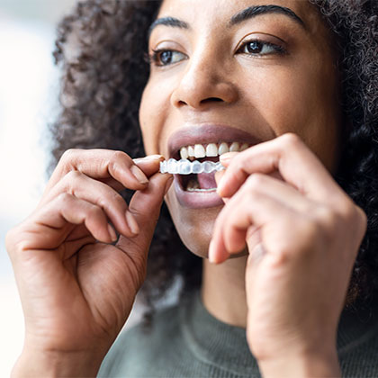 Woman placing Invisalign aligner
