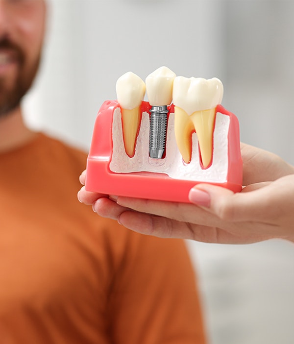 Model of an implant-supported crown