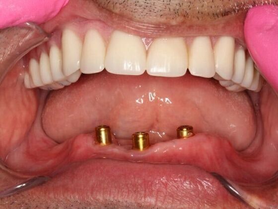 Before an implant denture from Ata Dental