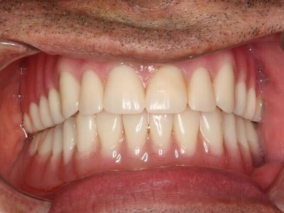 After an implant denture from Ata Dental