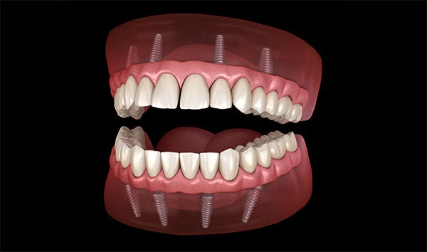 illustration of all-on-4 dentures