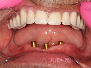 Mouth with three front implants in bottom arch