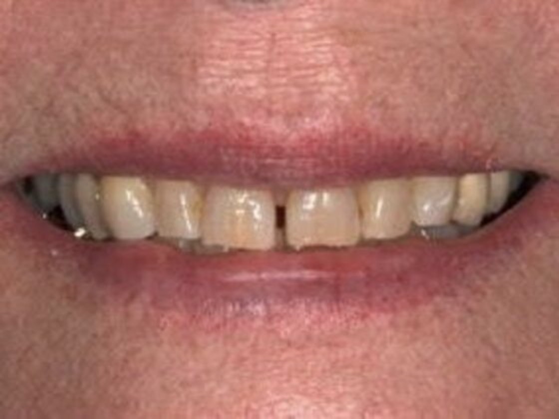 before smile makeover