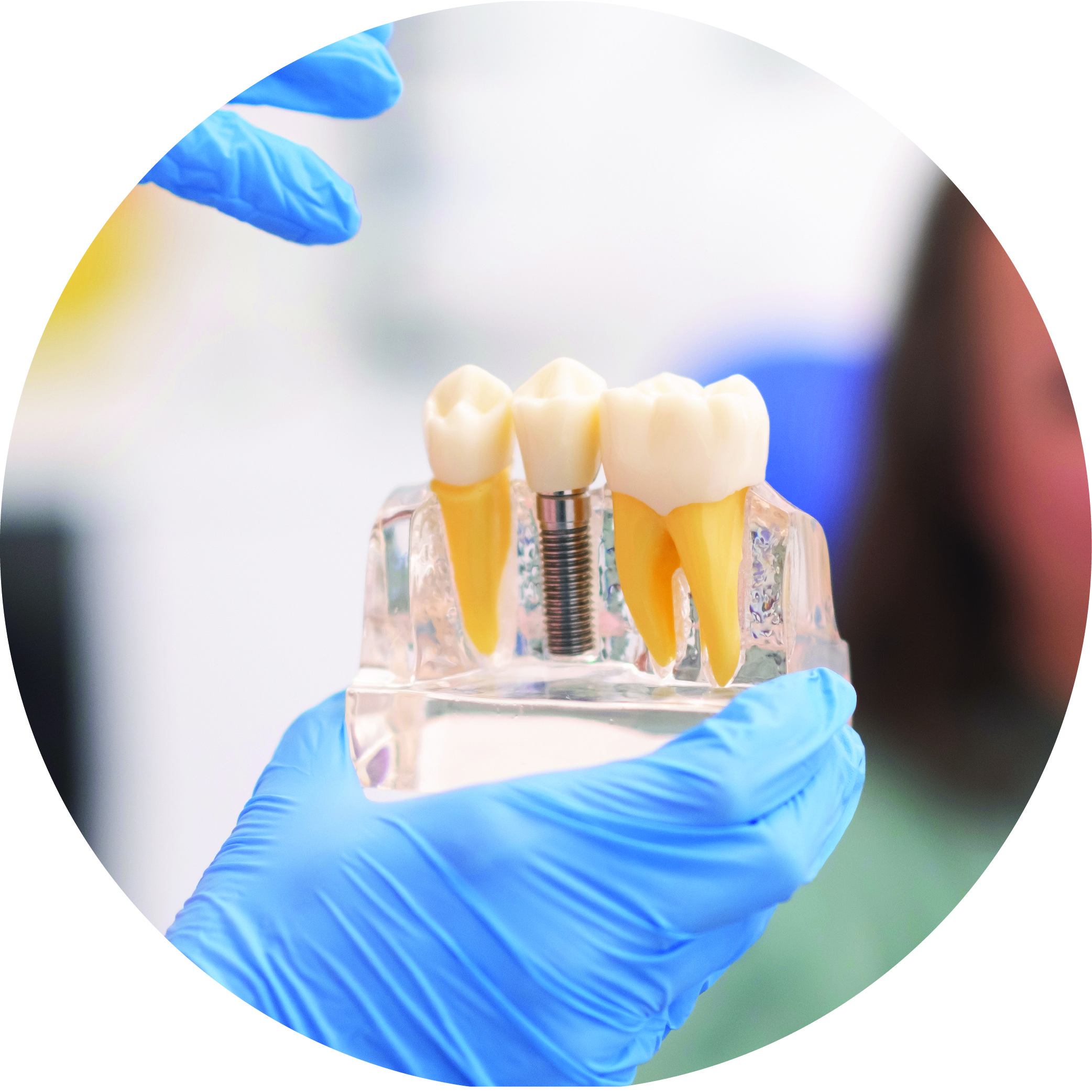 Model of an implant-supported crown