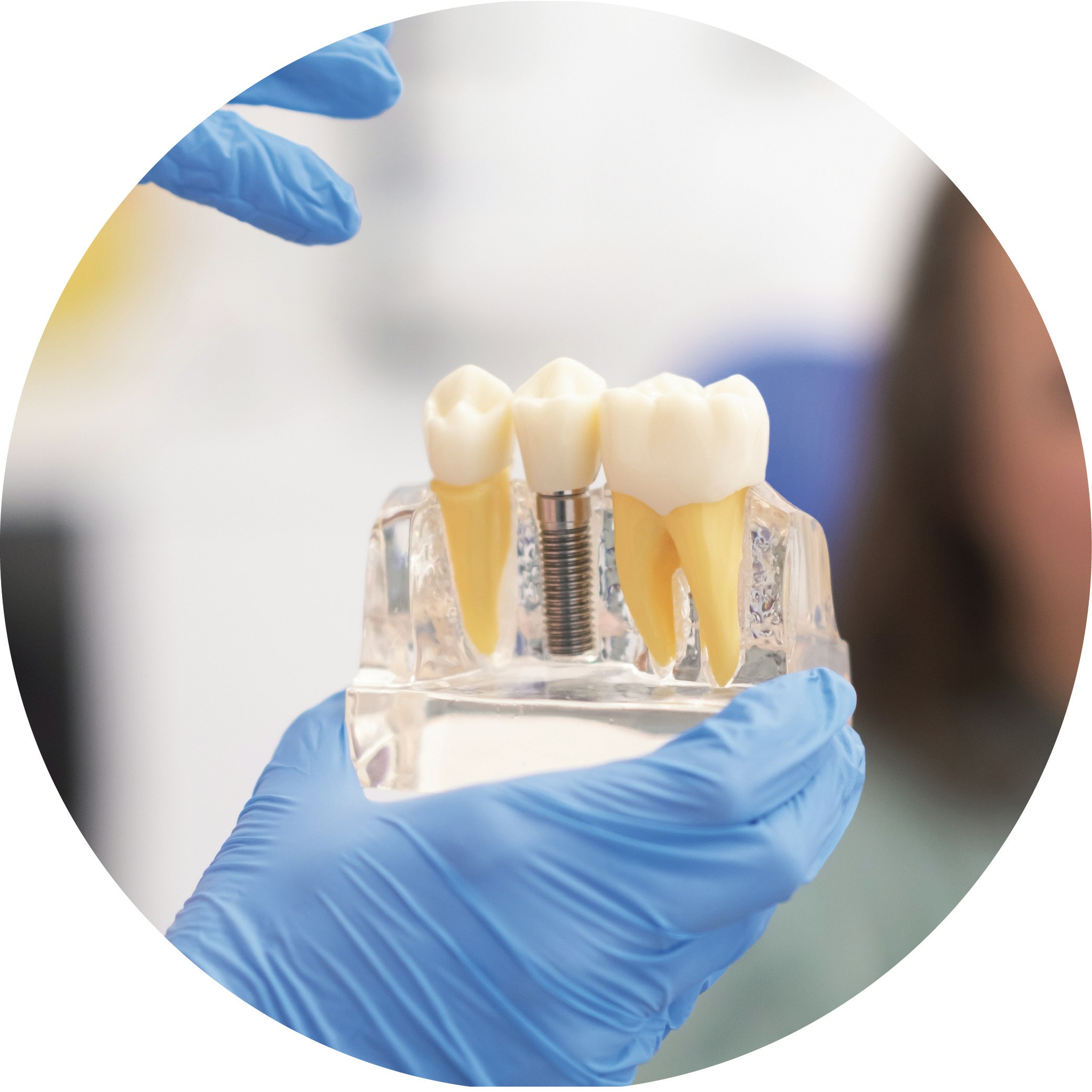 Model of an implant-supported crown