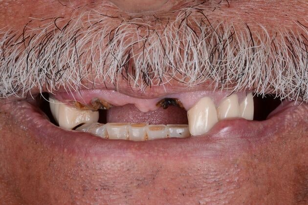 Before Full Mouth Reconstruction