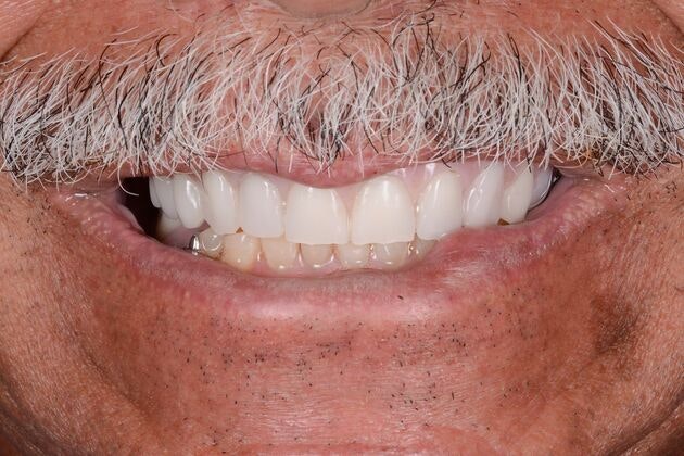 After Full Mouth Reconstruction