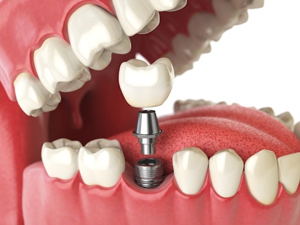 Dental implant being placed