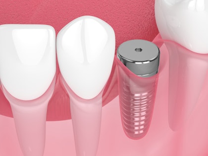 dental implant