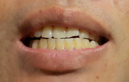 Yellowed teeth
