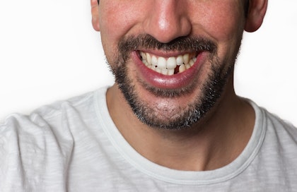 Man smiling with lower tooth missing