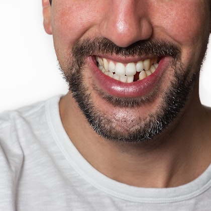 Man smiling with lower tooth missing
