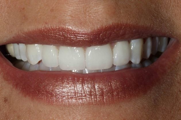 Dr. Mason Pirtle's patient after veneers