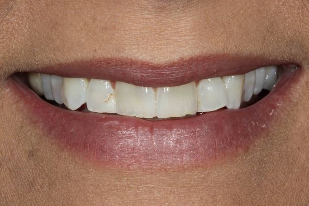 Dr. Mason Pirtle's patient before porcelain veneers
