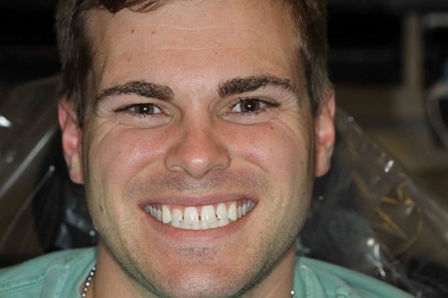 Dr. Mason Pirtle's patient before Smile makeover