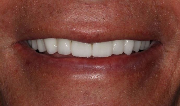 Precision Dental Partners Patient After Dental Implants