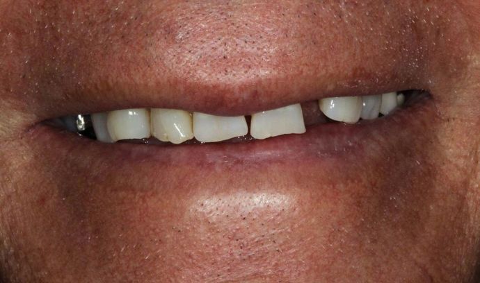 Precision Dental Partners Patient Before Dental Implants