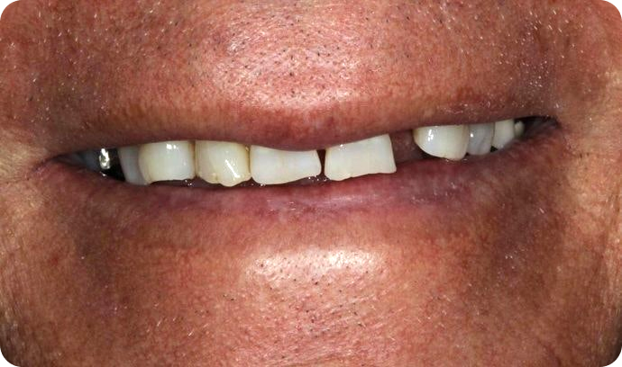 Precision Dental Partner Patient Before implants