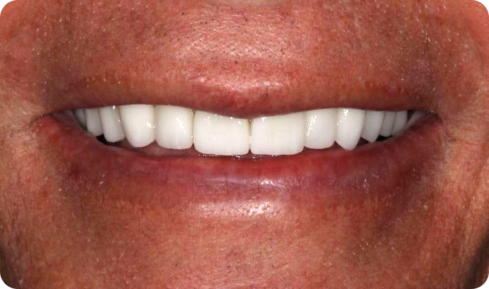 Precision Dental Partner Patient After implants
