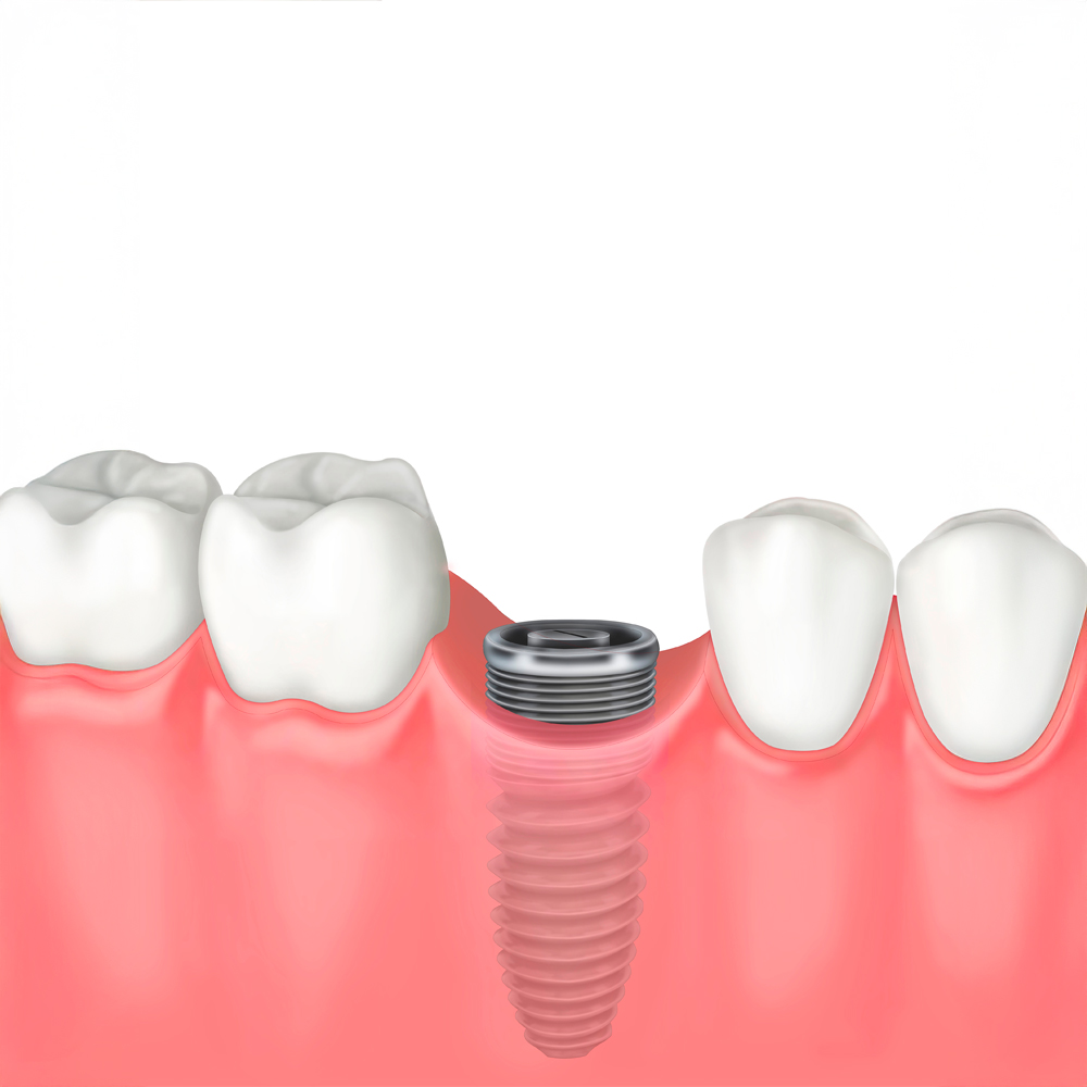 dental implant
