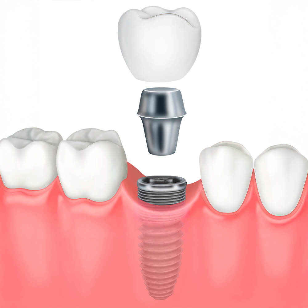 crown and dental implant