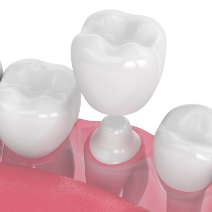 Dental Crowns