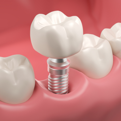 Dental Implants