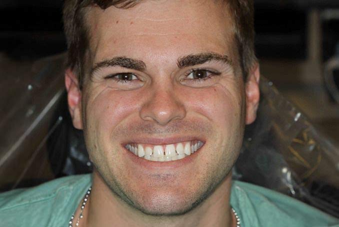 before invisalign