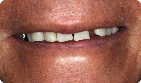 Precision Dental Partner Patient Before implants