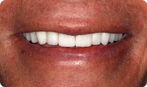 Precision Dental Partner Patient After implants