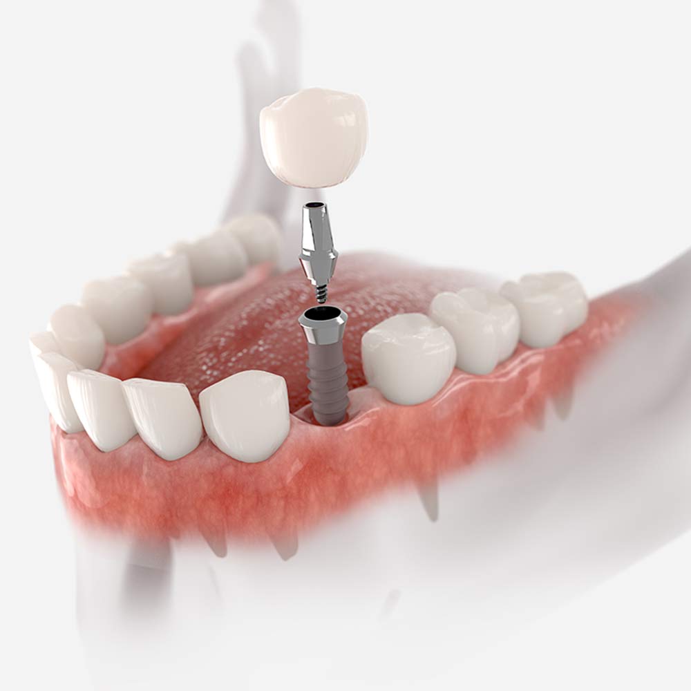 crown and dental implant