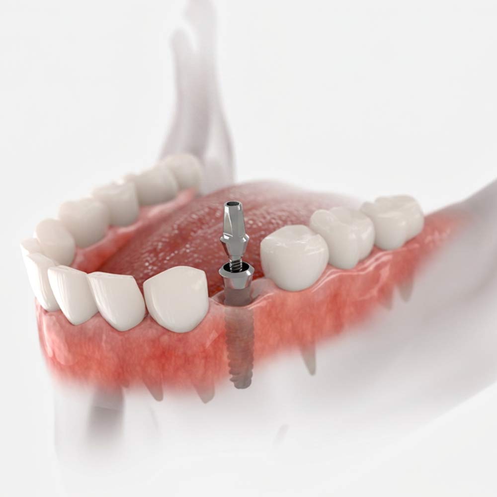 Abutment Piece